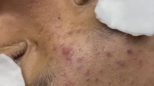 142 • Acne collection • АСМР • Relax Spa