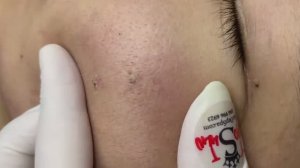 141 • Acne collection • АСМР • Relax Spa