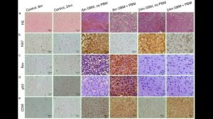 Age Differences in the Effectiveness of Phototherapy of Glioblastoma