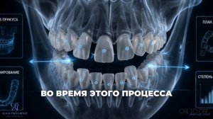Как работают элайнеры?