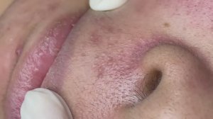 152 • Acne collection • АСМР • Relax Spa