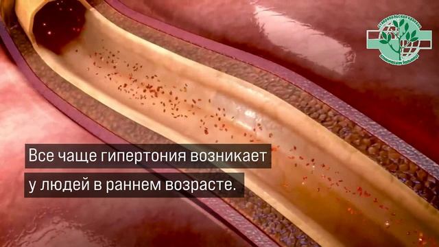 Гипертония