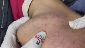 148 • Acne collection • АСМР • Relax Spa