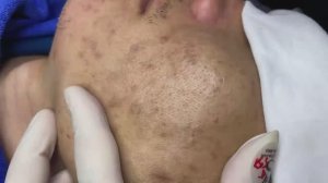 150 • Acne collection • АСМР • Relax Spa