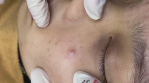 149 • Acne collection • АСМР • Relax Spa