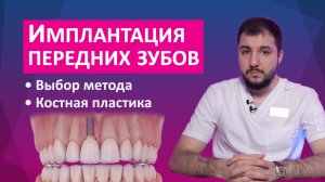 Имплантация передних зубов: методы, сроки, цены. Установка зубного импланта на передние зубы.