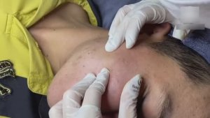Прыщи, скрывающиеся по всему лицу