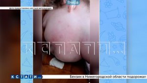 Смертельно опасные комары — укусы мутировавших насекомых вызывают отёки Квинке у взрослых и детей