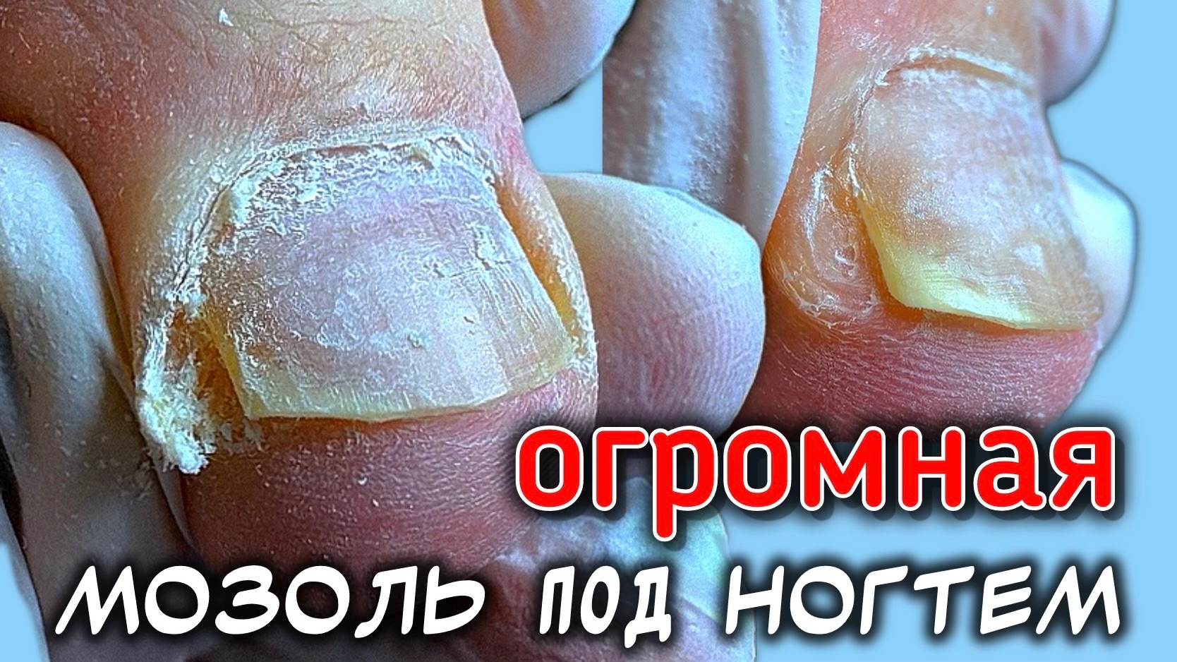 переносила титановую нить НО в целом результат вросшего скрученого ногтя отличный 👍🏼
