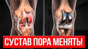 5 признаков, что пора ОПЕРИРОВАТЬ Коленный СУСТАВ! (не упусти этот момент)