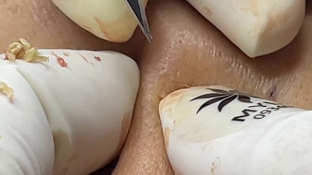 Гигантские угри. Расслабляющее лечение акне