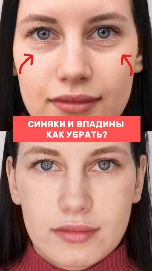Как убрать синяки и впадины под глазами?