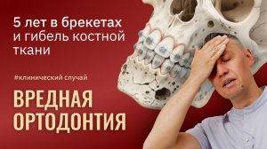 ВРЕДНАЯ ОРТОДОНТИЯ. 5 лет в брекетах и гибель костной ткани