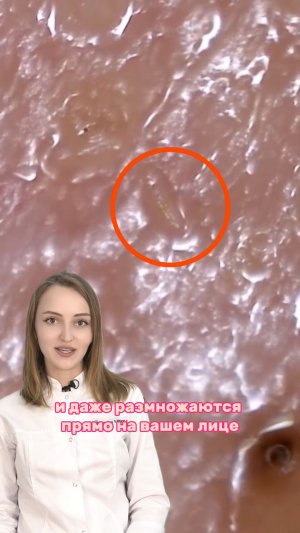 На твоем лице живет ЭТО. Клещ демодекс