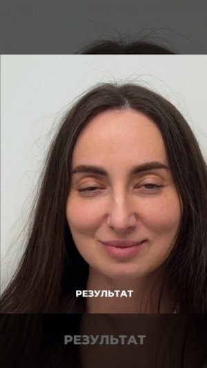 Эндоскопический лифтинг
