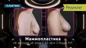 Маммопластика при тубулярной груди | Результат через год у Романа Редина