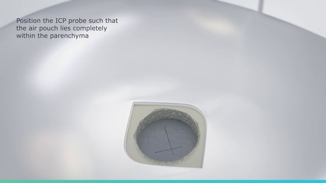 Parenchymal_probe_3pn