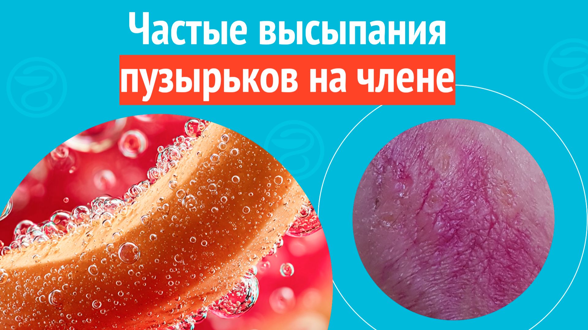 😯 Частые высыпания пузырьков на члене. Клинический случай № 1791 смотреть онлайн