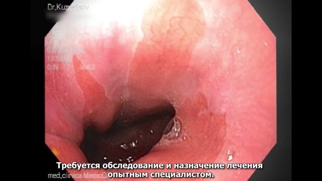 Диагностика и лечение гастрита и язвы желудка. Клиника 
