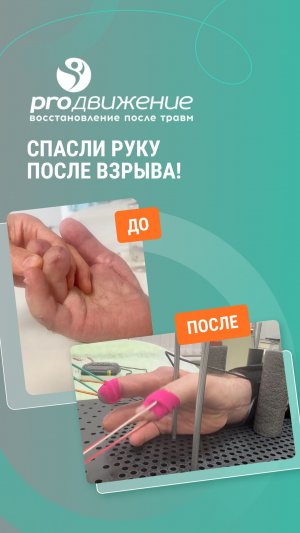 Травма руки от петарды: полное восстановление функций и реабилитация в клинике Продвижение