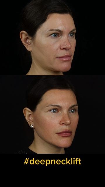 СМАС подтяжка лица и шеи, пластика нижних век.