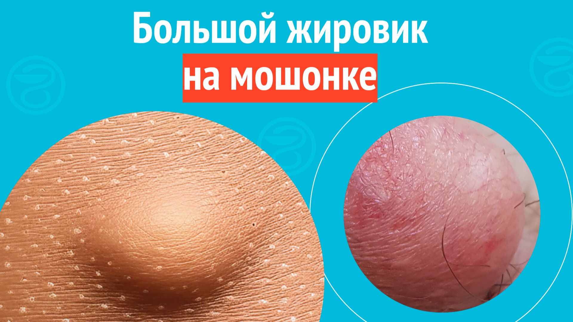 ☹️ Большой жировик на мошонке. Клинический случай № 1789
