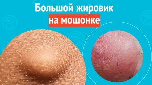 ☹️ Большой жировик на мошонке. Клинический случай № 1789