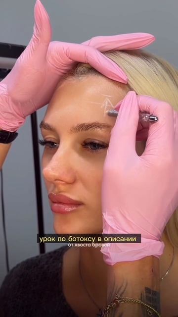 Лифтинг бровей ботоксом