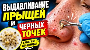 ВЫДАВЛИВАНИЕ ПРЫЩЕЙ. ЧАСТЬ 1