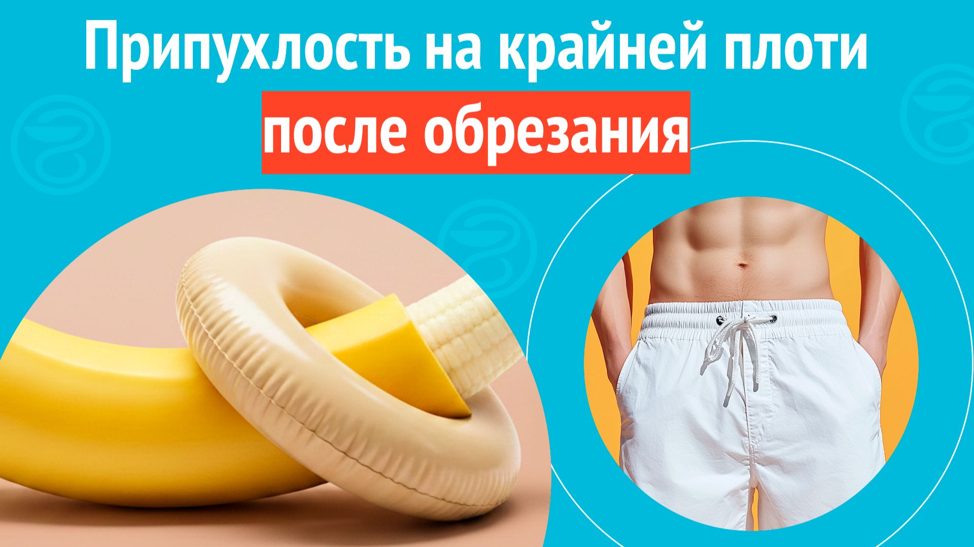 🥺 Припухлость на крайней плоти после обрезания. Клинический случай № 1787