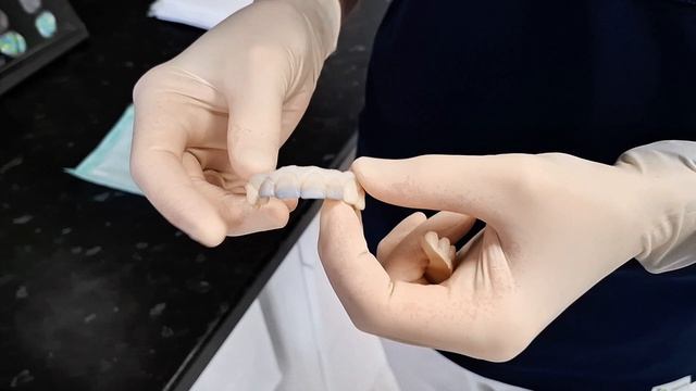 Поэтапная реставрация передних зубов | от планирования до результата #реставрациязубов #зубы