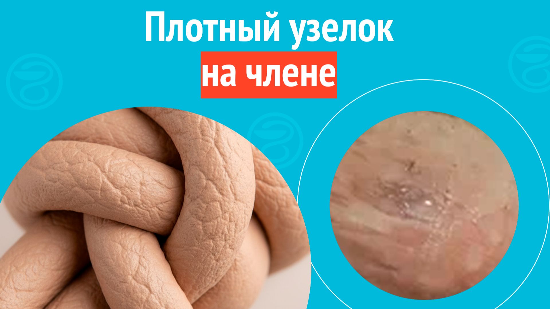 ⏯️ Плотный узелок на члене. Клинический случай № 1790 смотреть онлайн