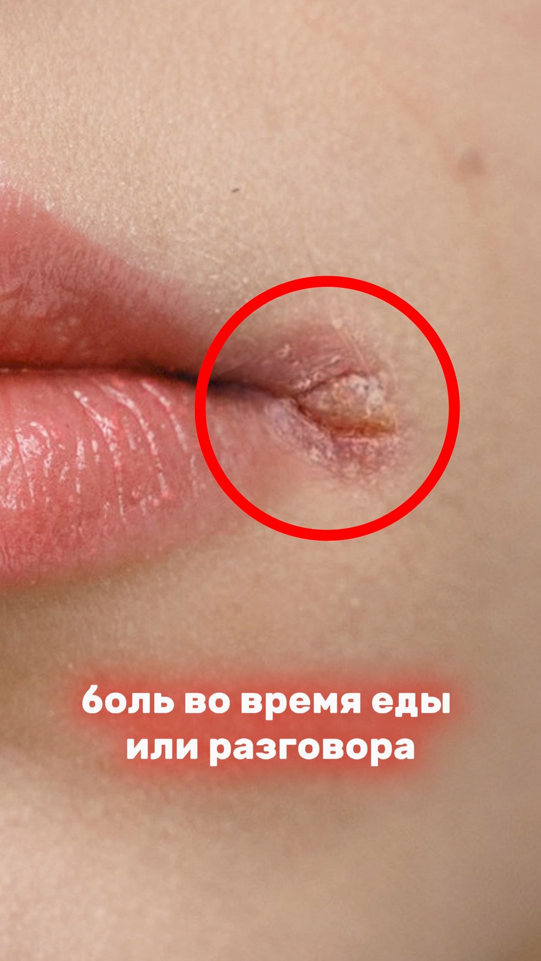 Трещины в уголках рта. Как избавиться? Почему появились заеды?