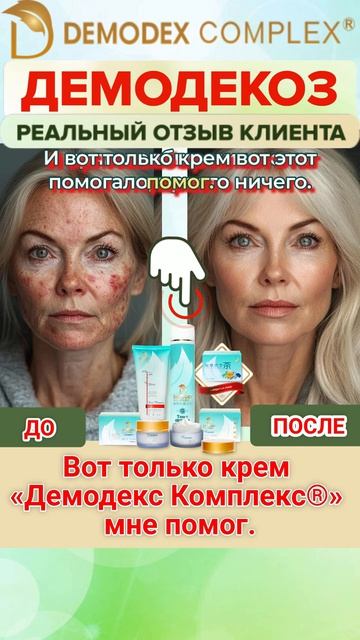 РЕАЛЬНЫЙ ОТЗЫВ КЛИЕНТКИ_ Крем помог там, где врачи бессильны!  #демодекс #демодекоз #демодекслечение