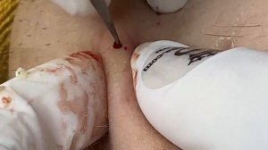 Удаление подкожных прыщей: полный цикл