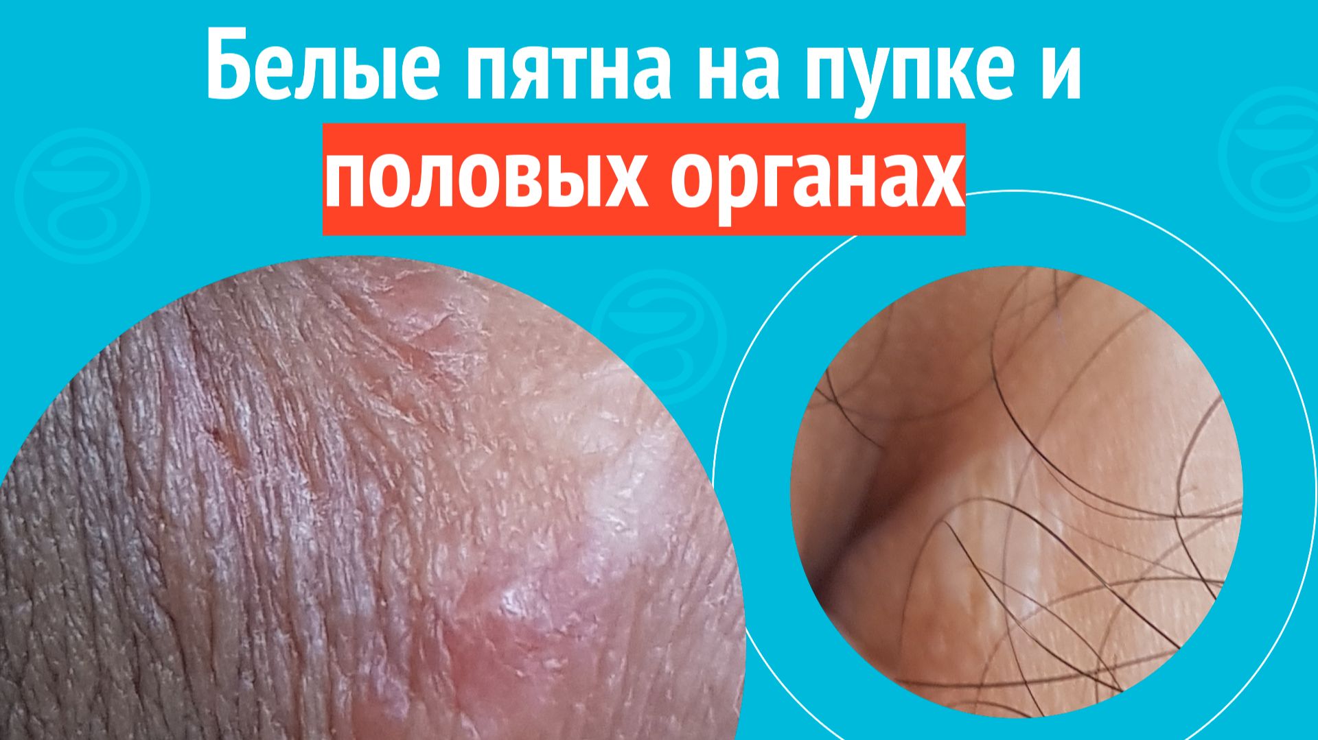 👉 Белые пятна на пупке и половых органах. Клинический случай № 1788