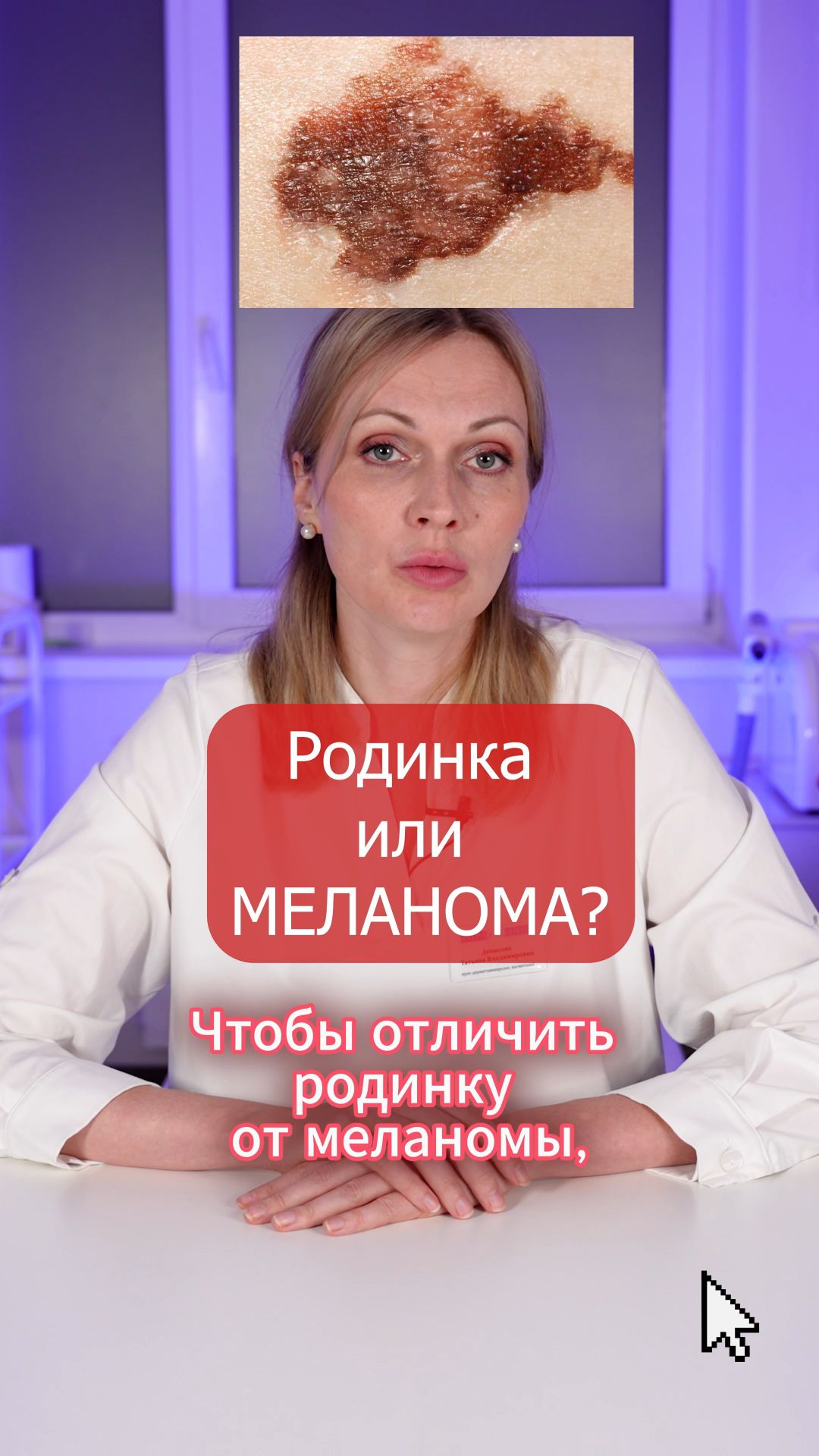 РОДИНКА или МЕЛАНОМА: КАК выглядит РАК КОЖИ?