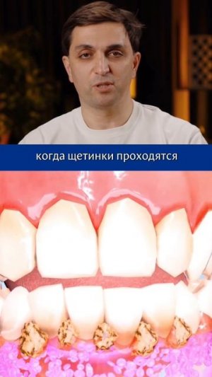 Почему при чистке зубов появляется кровь