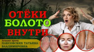 Отеки уйдут навсегда: рабочий способ. Как избавиться от ОТЕКОВ!