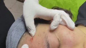 Чистка лица: удаление прыщей и черных точек