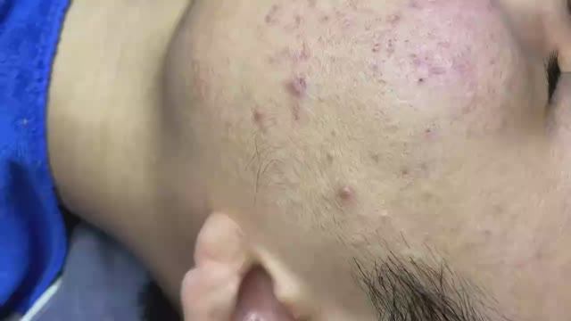155 • Acne collection • АСМР • Relax Spa