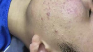 155 • Acne collection • АСМР • Relax Spa
