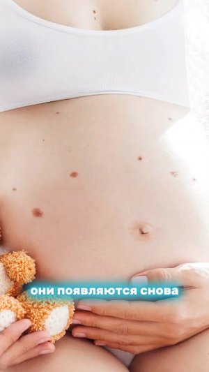 РОДИНКИ при беременности: ОПАСНЫ ли?