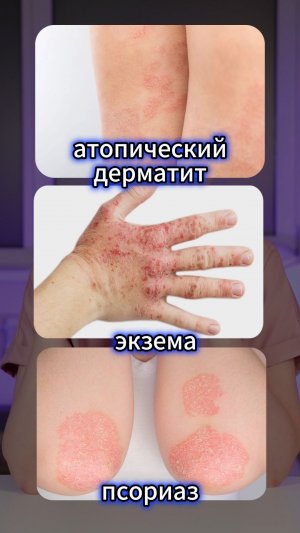 ТРИГГЕР для псориаза, экземы, атопического дерматита