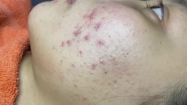 #3 Удаление прыщей. Экстрация комедонов. Подкожные прыщи. Чистка от черных точек
