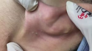 156 • Acne collection • АСМР • Relax Spa
