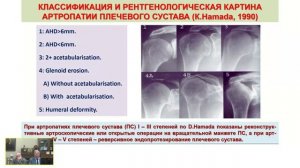 Современные возможности артроскопического трансфера сухожилий и послеоперационной реабилитации...
