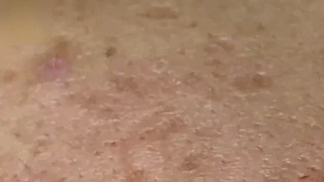 #7 Удаление прыщей. Экстрация комедонов. Подкожные прыщи. Чистка от черных точек