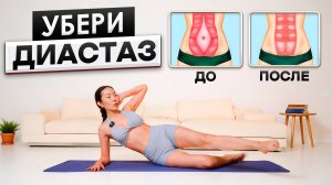 Избавься от ДИАСТАЗА за 1 МЕСЯЦ! Простые Упражнения которые работают!
