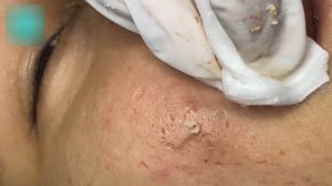 Профессиональная экстракция акне у косметолога